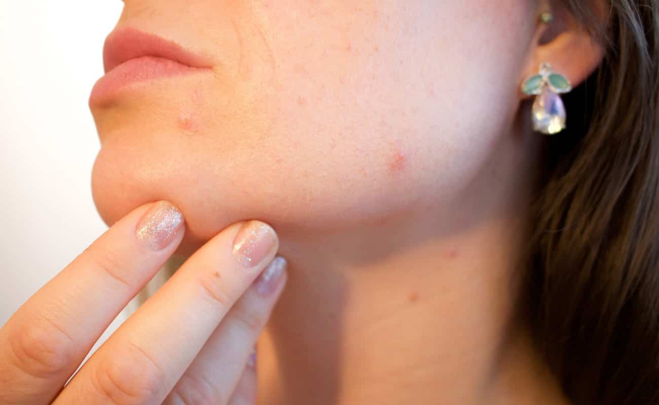 come-combattere-l’acne-con-la-cosmesi-naturale